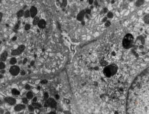 F,3y. | extracellular cholestasis- reduced microvilli in primary bile duct